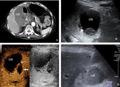 Improved detection of gallbladder perforation by contrast-enhanced ultrasound: two case reports